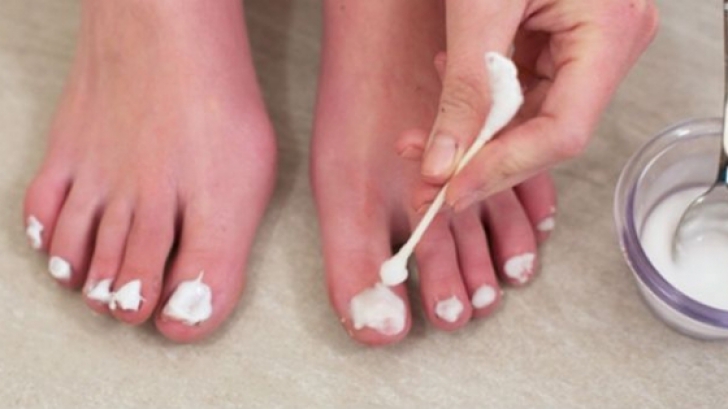 tratament cu bicarbonat de sodiu pentru ciuperca unghiilor de la picioare