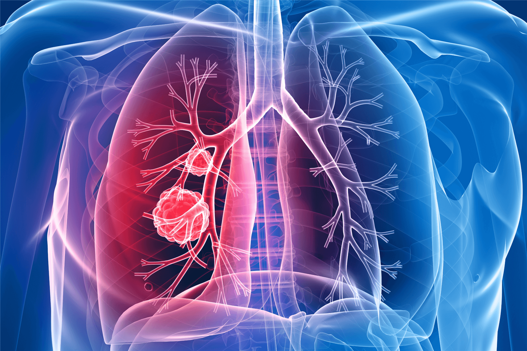 reprezentare 3d a cancerului pulmonar