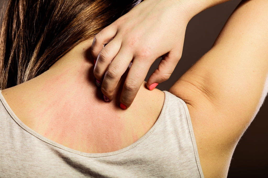 femeie care sufera de mancarimi pe spate cauzate de pielea uscata
