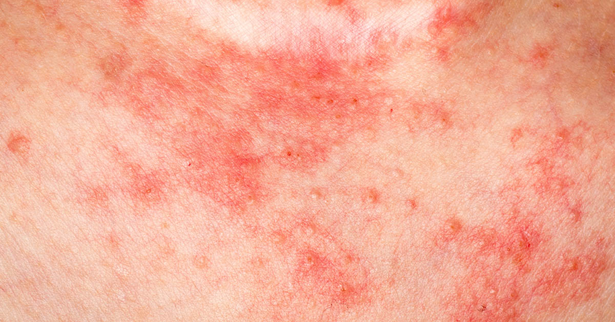 eczemă pe piele