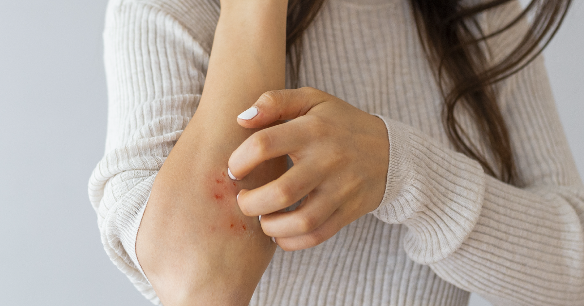 Ce este eczema și ce tratament recomandă medicii pentru ameliorarea simptomelor? Iată cum prepari un unguent eficient acasă