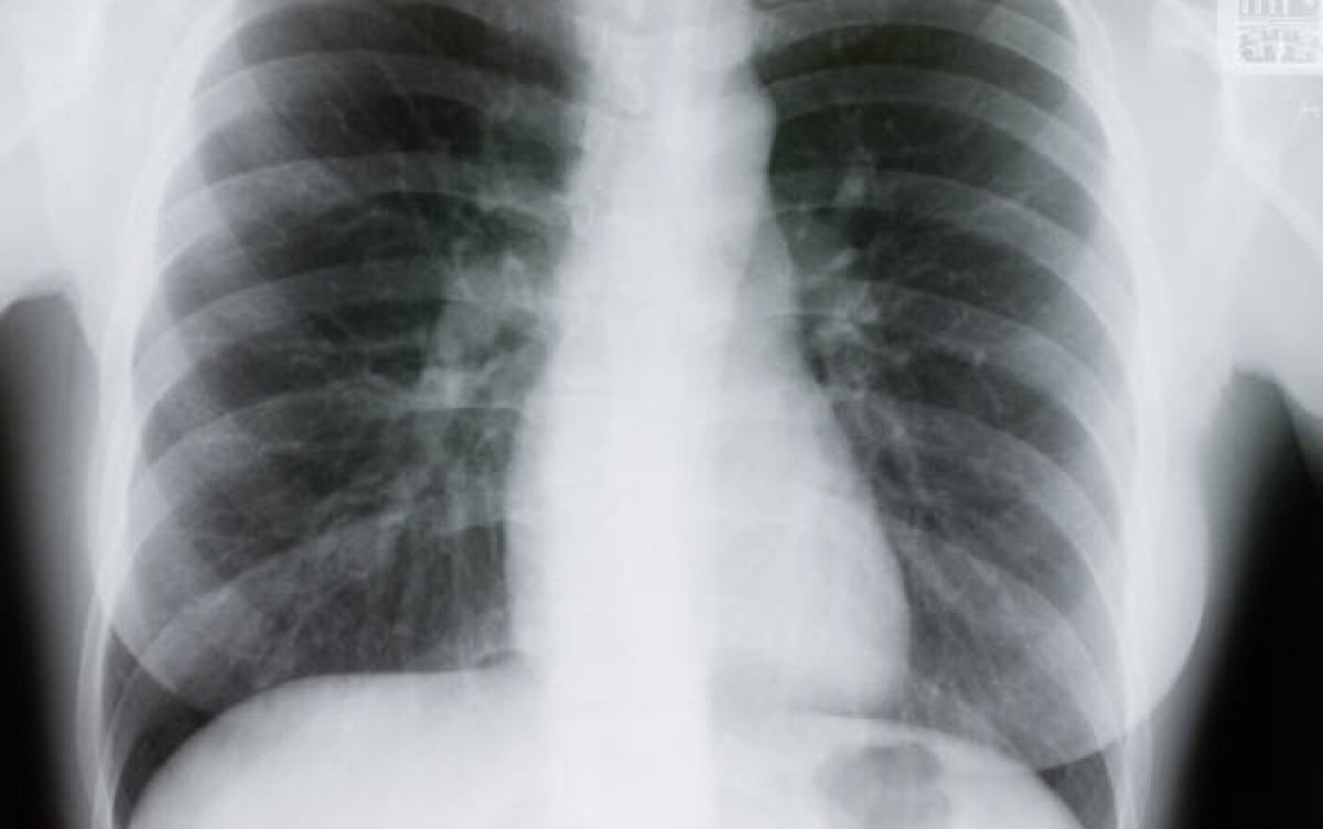 Ce este radiografia la plămâni? Află cum se realizează și când este recomandată