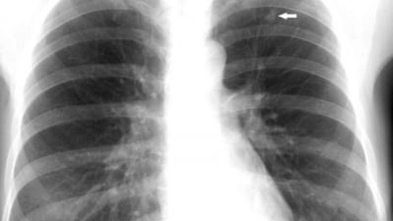 o radiografie pulmonară