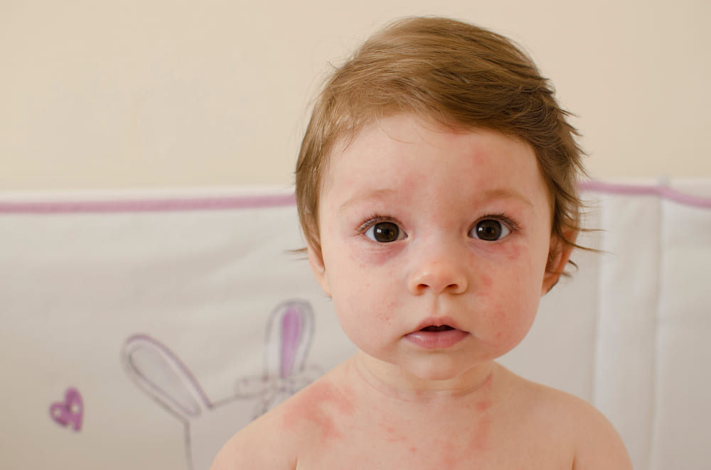 Roseola infantum poze. Cum se manifestă afecțiunea și cum poate fi tratată