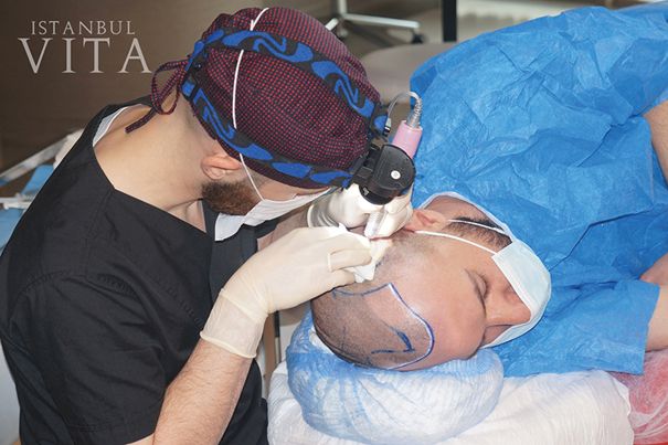 Cel mai bun implant de păr din Turcia – Istanbul Vita