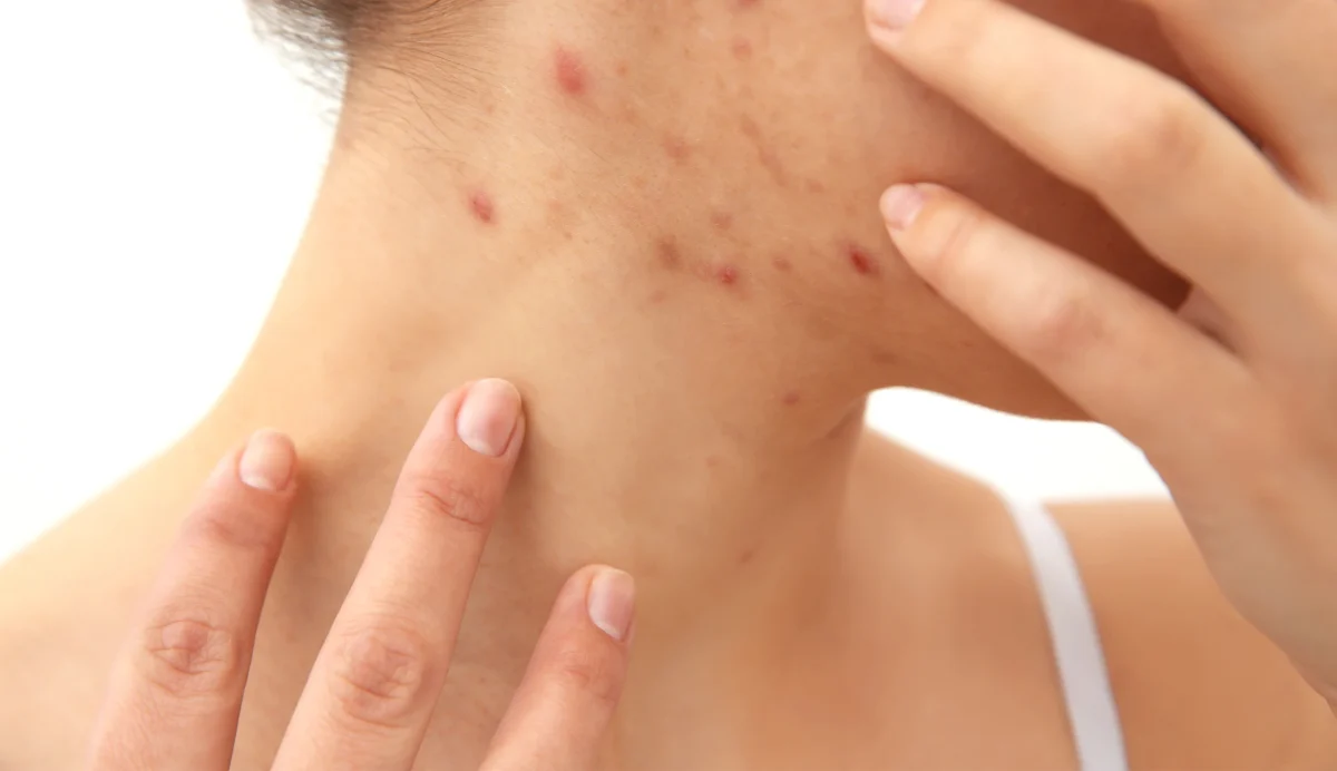 Boli de piele – poze. Cum să identifici afecțiunea în timp util