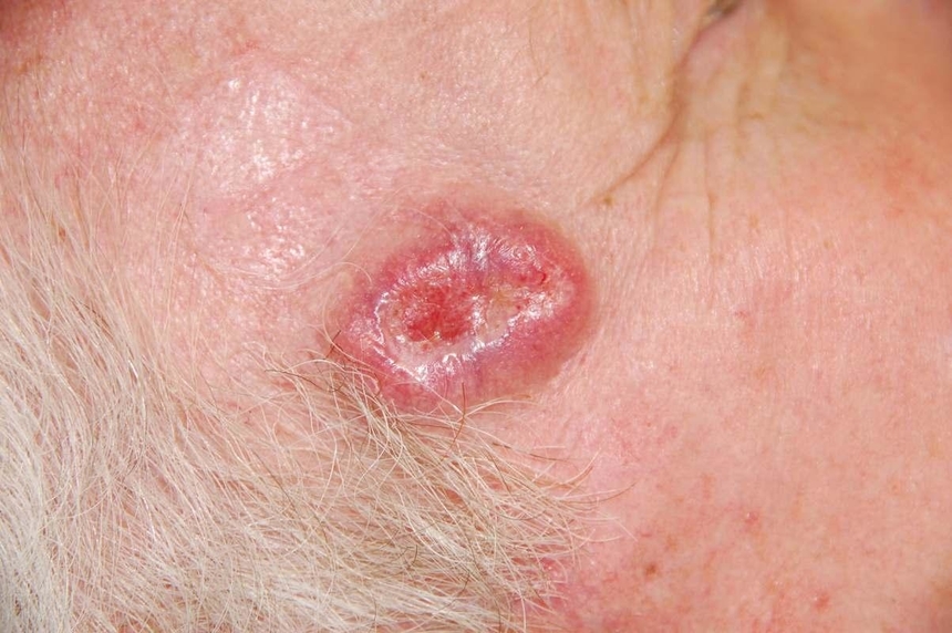 Cancer de piele imagini. De ce se dezvoltă melanomul?