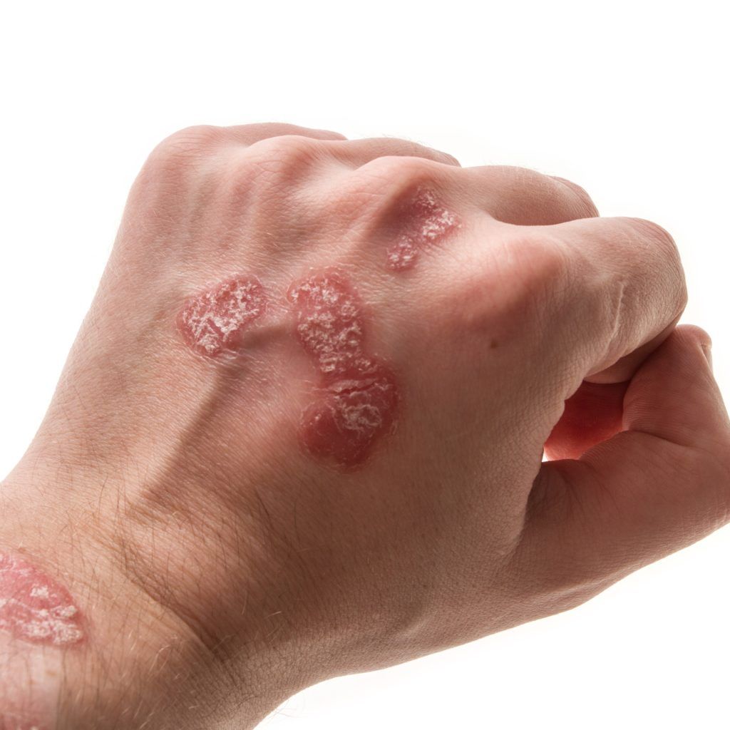 Tipuri de eczemă – poze. Senzațiile provocate de cele mai contagioase afecțiuni