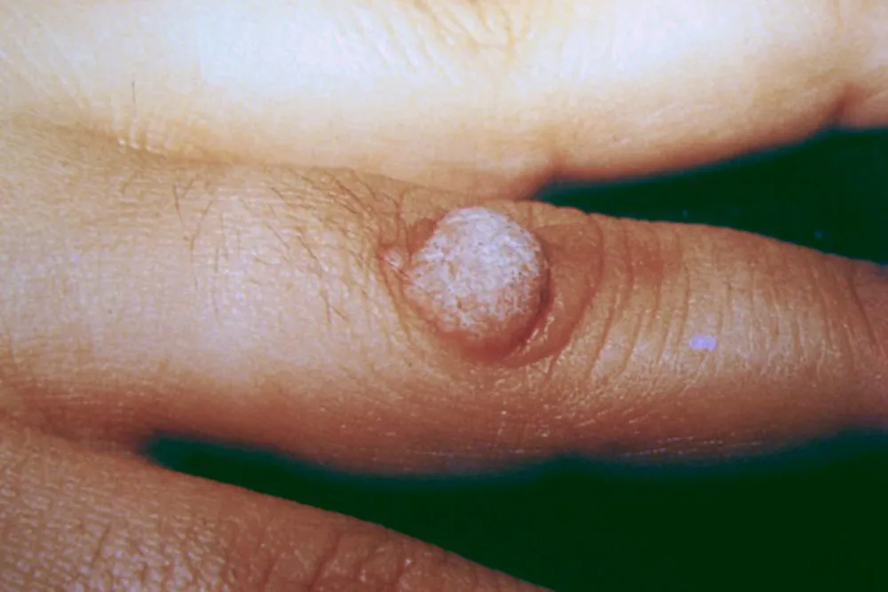 Virusul HPV – poze. Cele mai periculoase forme ale afecțiunii