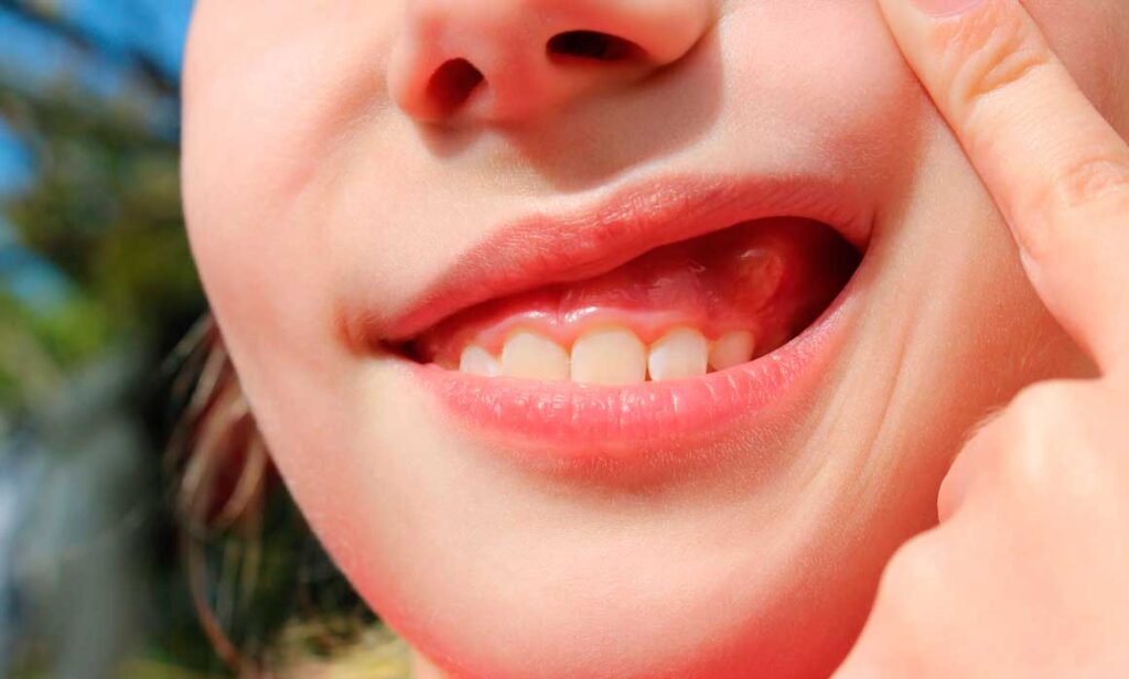 Abcesul dentar se sparge singur. Cum să intervii imediat pentru a calma durerea folosind remedii naturiste
