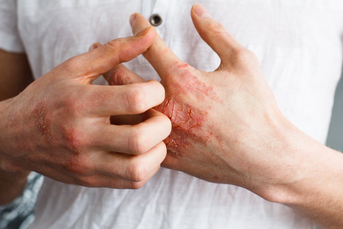 Unguent cu antibiotic pentru eczeme. Cum să scapi rapid de semnele roșii de pe mâini