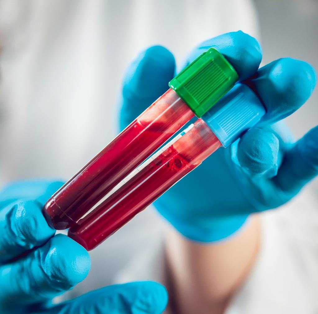 Valorile colesterolului în funcție de vârstă. Indicii considerați normali de către specialiști