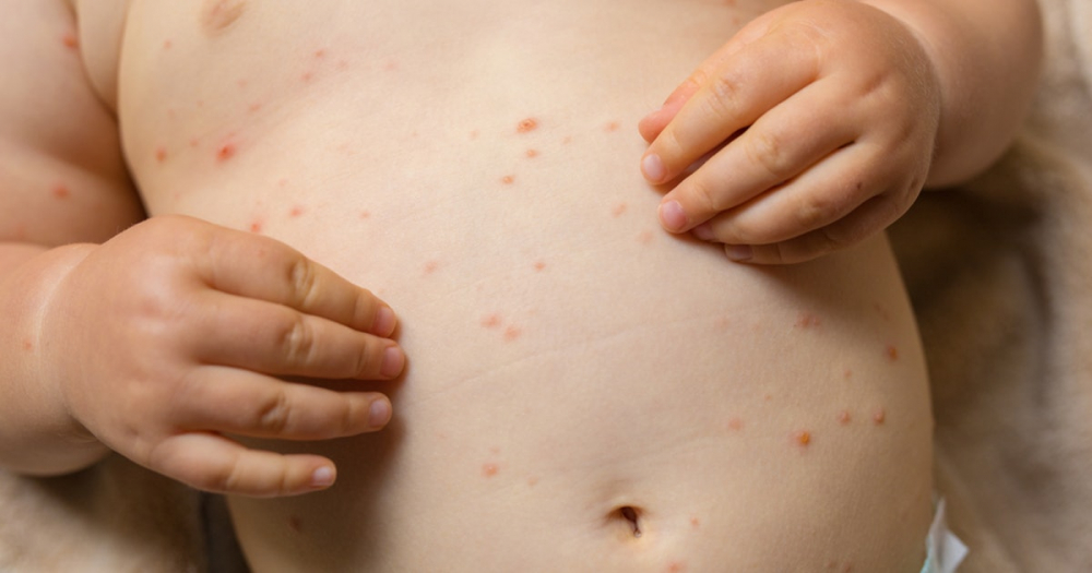 Varicela prima zi. Care sunt primele simptome provocate de virus