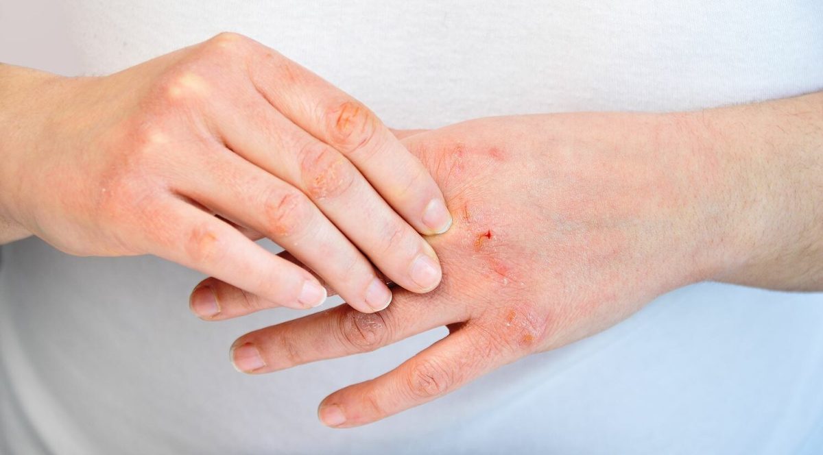 Alergie la frig. Cele mai eficiente metode pentru a preveni manifestarea simptomelor neplăcute