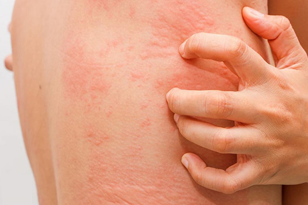 Poze-alergii cutanate. Ce include terapia pentru tratarea afecțiunilor dermatologice