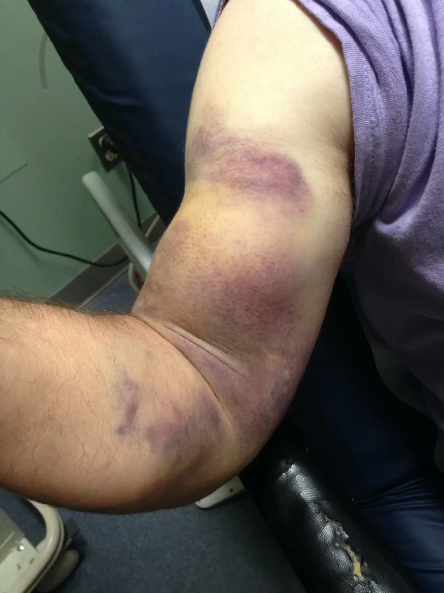 Ruptură musculară. Cum afectează incidentul calitatea vieții pacientului