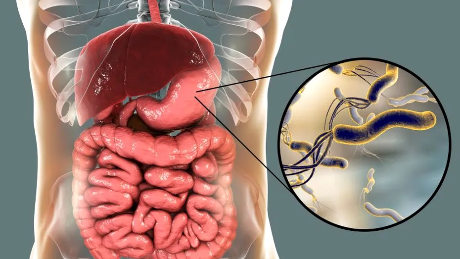 Helicobacter pylori provoacă infecții stomacale. Cum poți ști dacă suferi de acest tip de bacterie