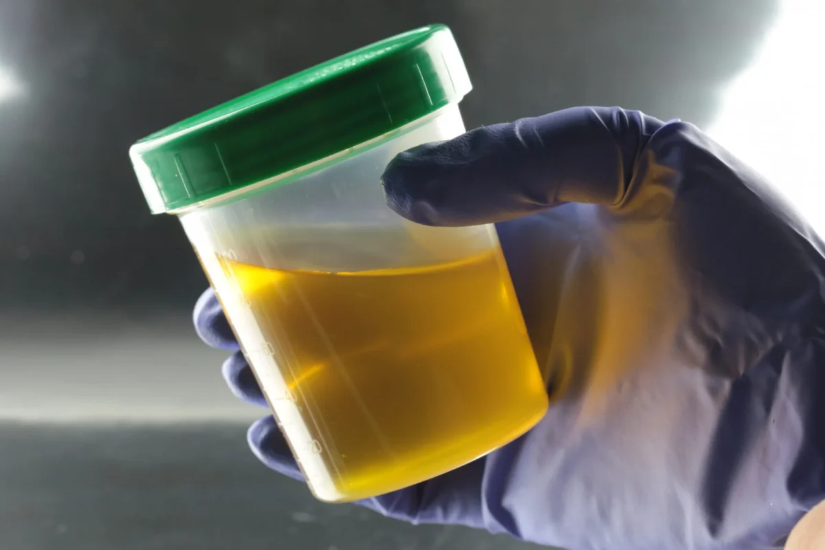 Bacterii în urină. Ce analize se fac pentru identificarea problemei