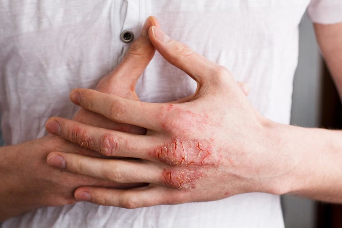 Dermatita herpetiformă. Tratează rapid petele și erupțiile cauzate de boală