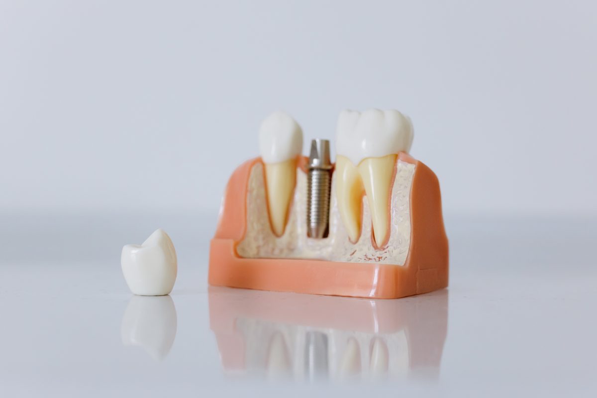 Îți dorești restaurarea dentară cu ajutorul implantului? Află care sunt complicațiile și contraindicațiile acestuia