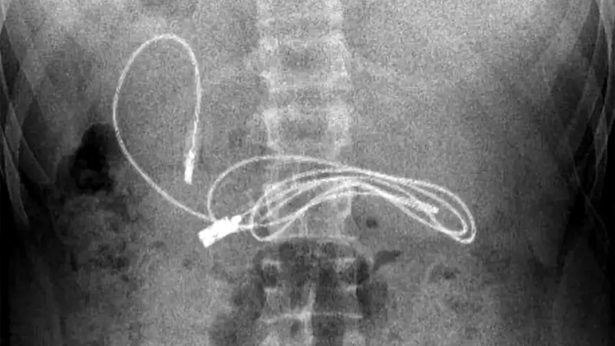 Medicii au crezut că nu văd bine! Ce gadget au putut găsi în stomacul unui adolescent care acuza dureri de burtă
