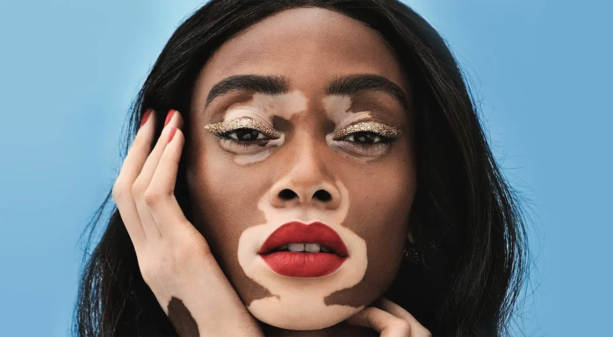 Vitiligo-poze. Din ce cauză apare afecțiunea dermatologică și cum să stopezi dezvoltarea acesteia?