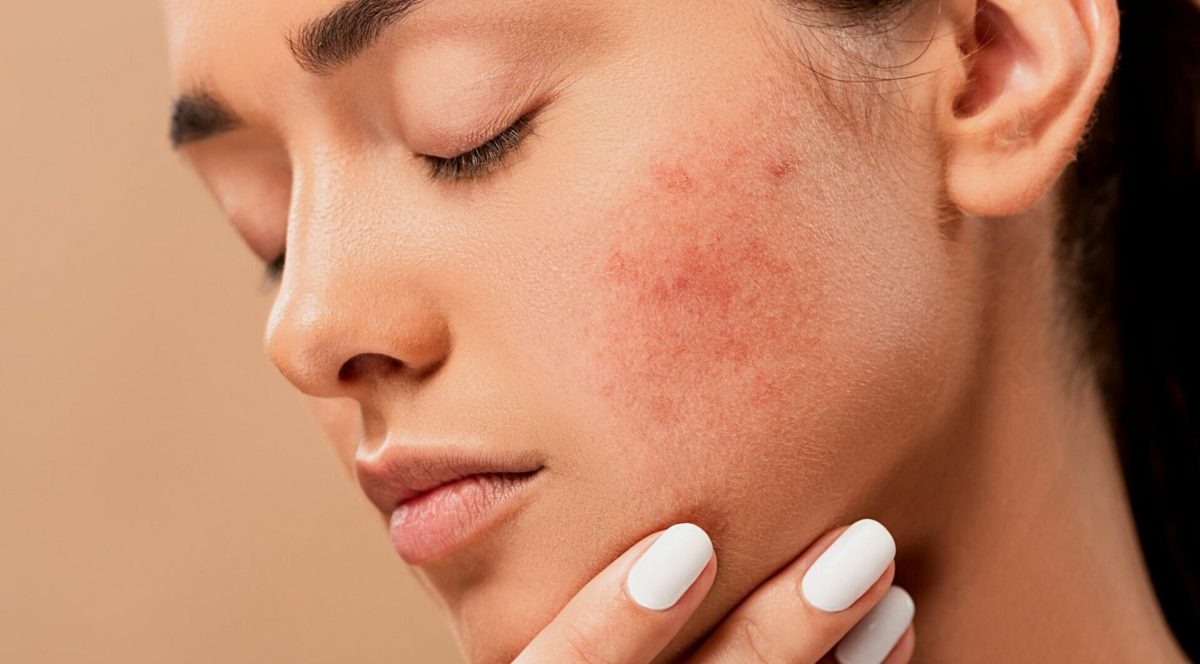 Acnee comedoniană. În ce situații are loc modificarea cantității de sebum?