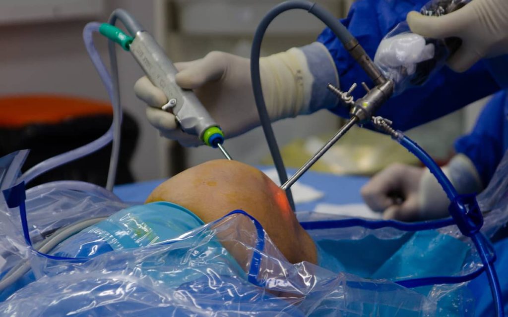 Artroscopia de genunchi: o metodă avansată de diagnostic și tratament pentru afecțiunile articulare – VIDEO