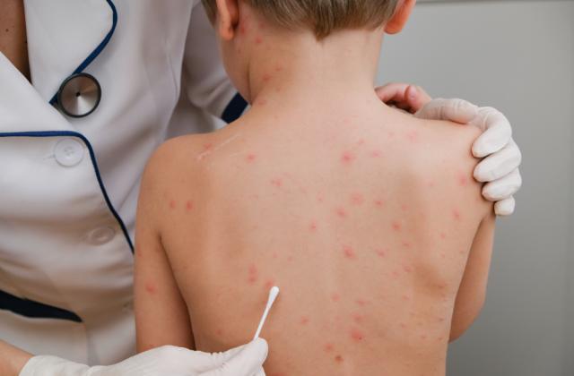 Copil de 7 ani cu o formă de varicelă foarte rară, internat la Spitalul de Boli Infecțioase din Timișoara