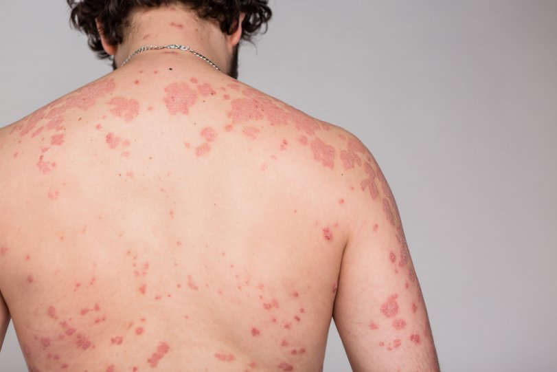 Poze cu boli de piele. Cele mai grave și frecvente afecțiuni dermatologice