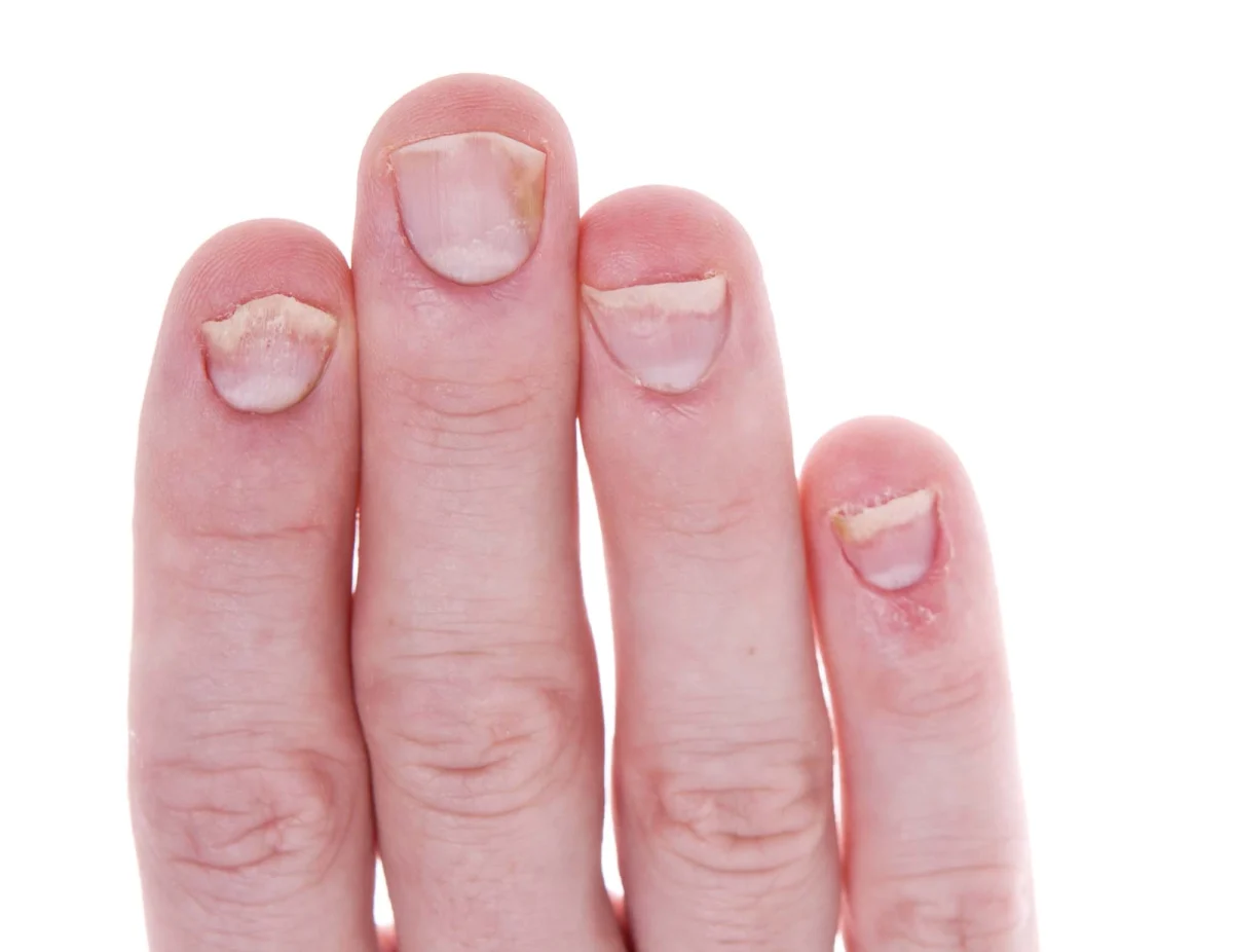 Psoriazis unghii. Manifestările bolii și terapia recomandată de medici