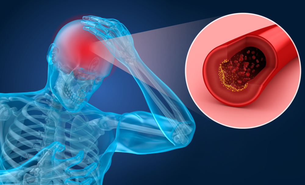 Riscul unui accident vascular cerebral diferă în funcție de grupa sanguină. Care este grupa cea mai predispusă unui AVC