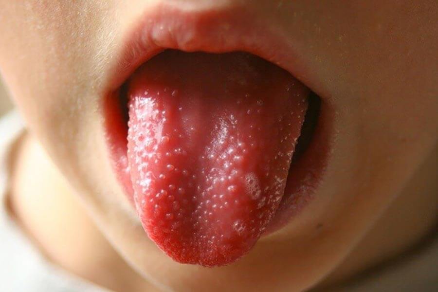 Scarlatina la copii. Cum pătrunde în organism agentul patogen?