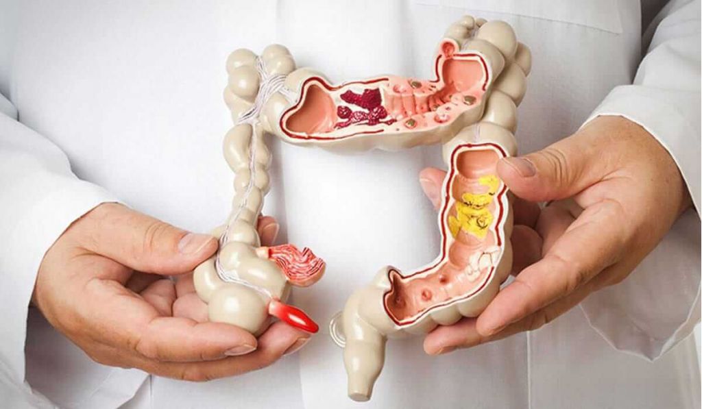 Cancer de colon – poze. Din ce cauze apare tumora?