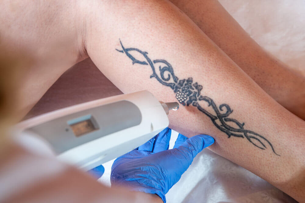 Cum pot fi îndepărtate tatuajele? Iată care sunt cele mai cunoscute și eficiente metode – VIDEO