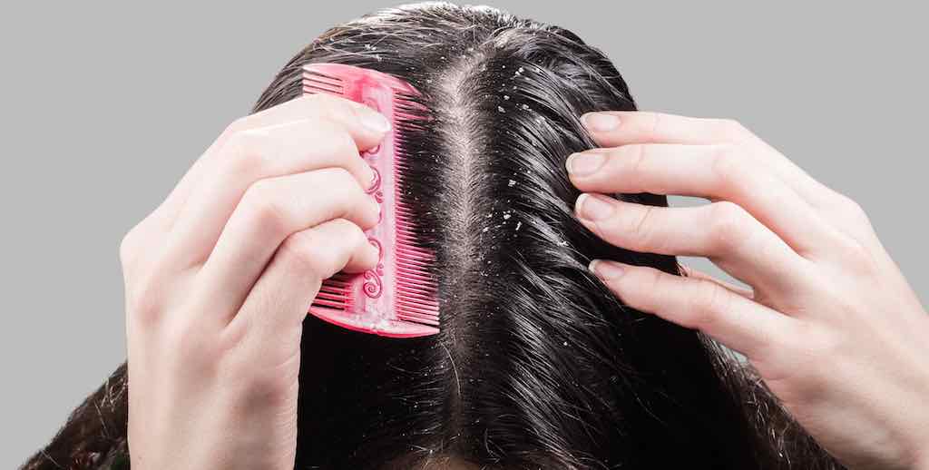 Scalp iritat. Remedii naturiste pentru mâncărimile de la nivelul scalpului