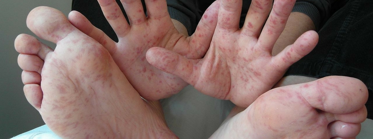 Septicemie simptome. Care este reacția organismului la infecție?