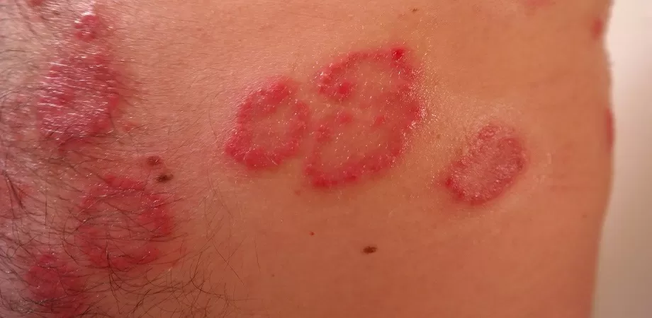 Unguent pentru pecingine. Remedii care pot elimina simptomele asociate infecției