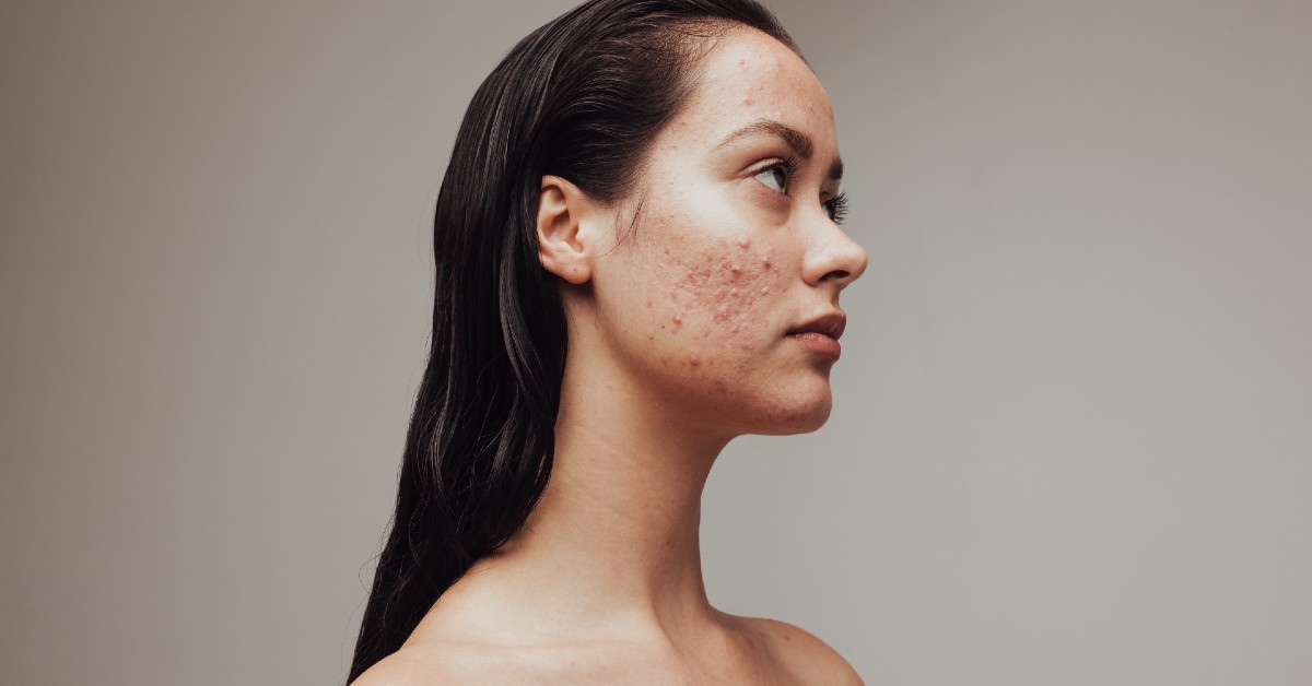 Acnee chistică. Când este cazul să consulți un dermatolog pentru a obține un tratament eficient?