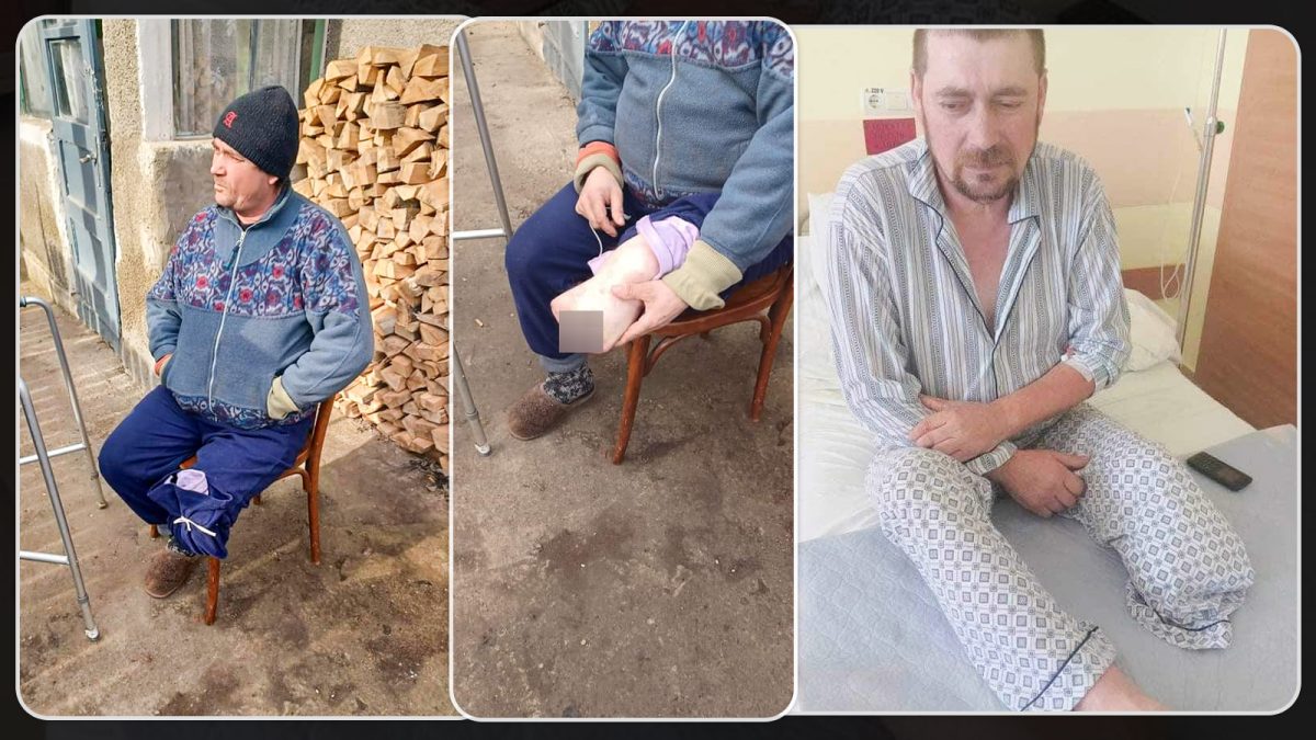 Frica de doctor l-a adus în scaunul cu rotile. A ajuns de urgență la spital, dar era prea târziu. Medicii au fost obligați să-i amputeze un picior – FOTO