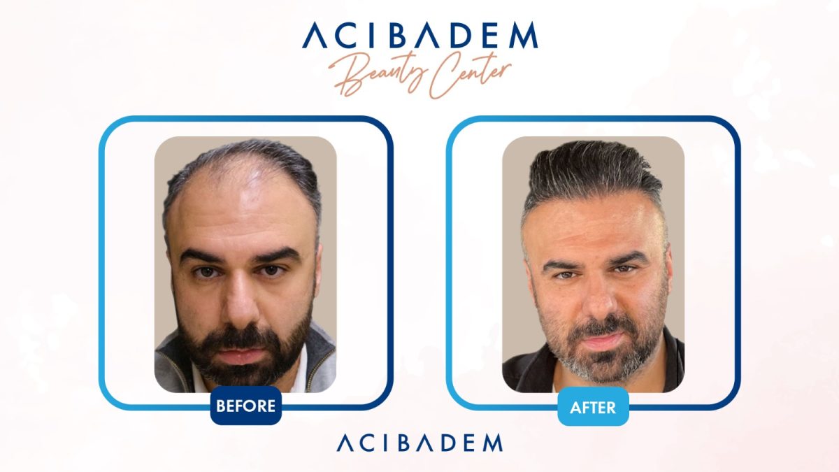 Acibadem Beauty Center: Locul Sigur din Turcia Pentru Transplantul de Păr