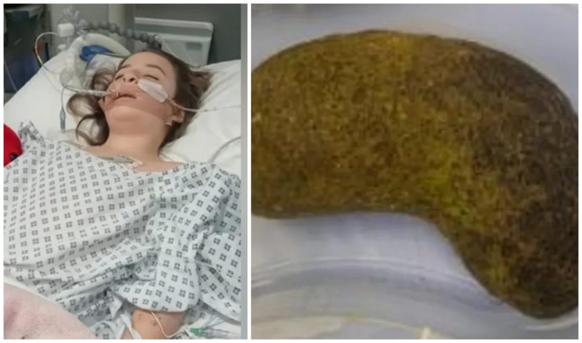 Ce au descoperit medicii în stomacul unei fetițe de 7 ani. Micuța acuza dureri abdominale severe și greață
