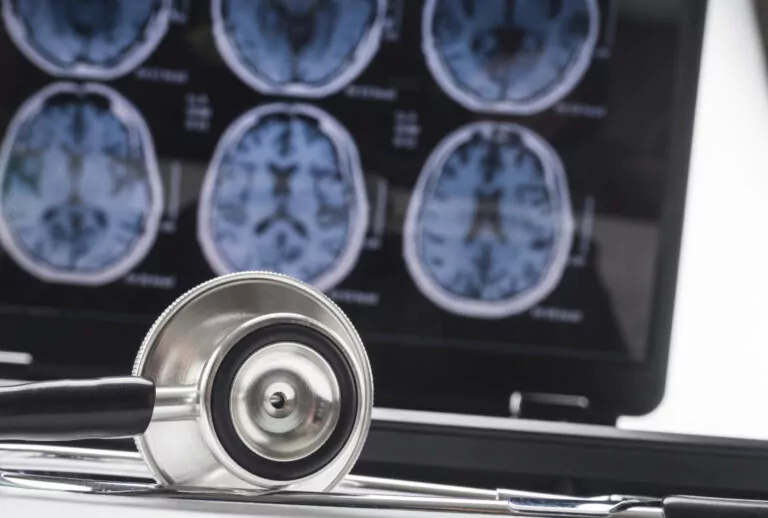 Instrumentul AI ce poate prezice boala Alzheimer! Cercetătorii sunt foarte încrezători în șansele de reușită
