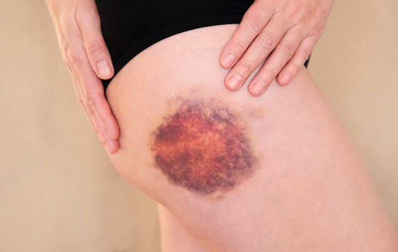 Diferența dintre un hematom sub piele și o vânătaie. Când e cazul să mergi la medic
