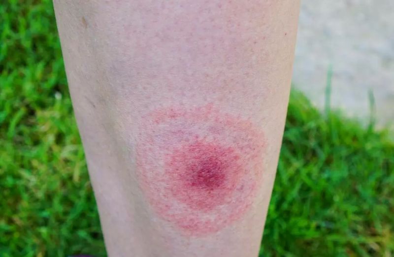 Poze boala Lyme – tot ce trebuie să știi despre această infecție