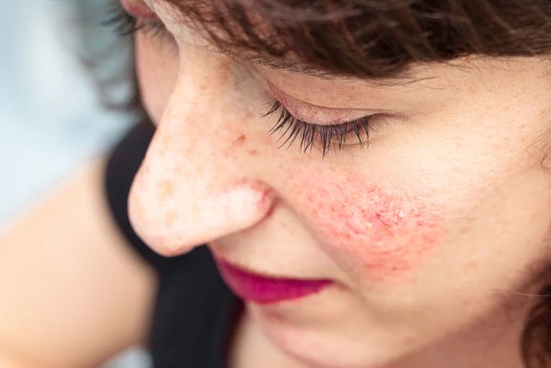 De ce apare acneea rozacee? Metode de tratament a tenului afectat