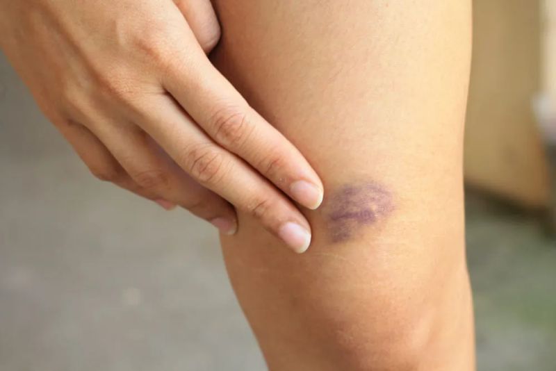 Ce este hematomul, poze și de ce apare. Ce semnale de alarmă ar trebui să-ți atragă atenția