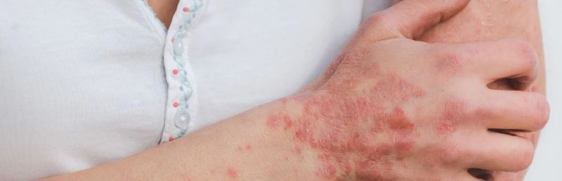 Psoriazis tratament. De ce apare această afecțiune a pielii?