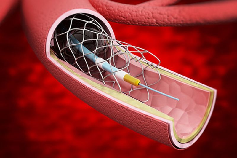 Stent la inimă. Ce presupune procedura și care sunt riscurile ei