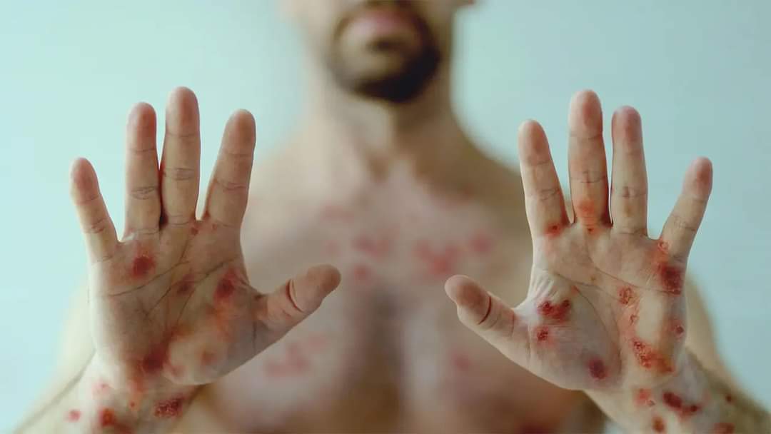 Tudor Ciuhodaru, medic ieșean: „Variola maimuței (monkeypox) este o infecție virală rară care se poate răspândi la om și care face parte din aceeași familie virală cu variola”